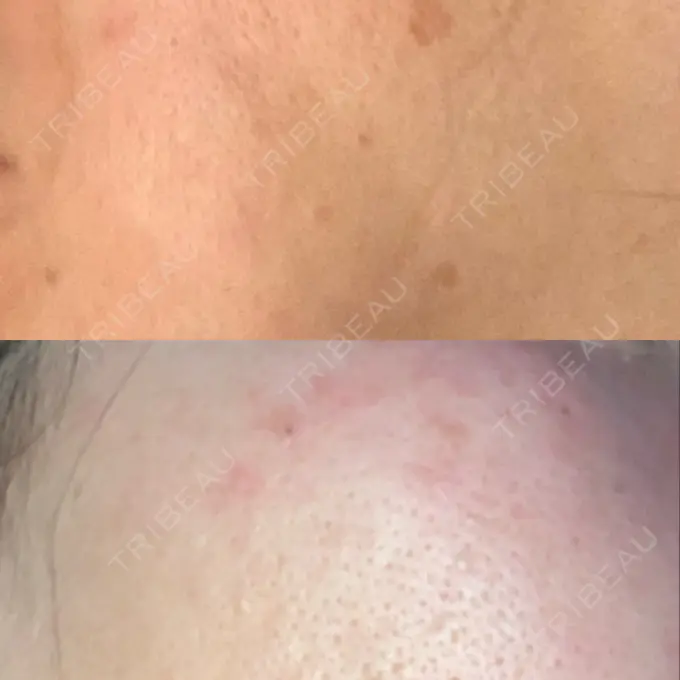 ピーリング（ニキビ・毛穴） / イオン導入 / エレクトロポレーション / 毛穴洗浄（ハイドラフェイシャルなど） あおばクリニック 横浜院 DAY 16 メイン用