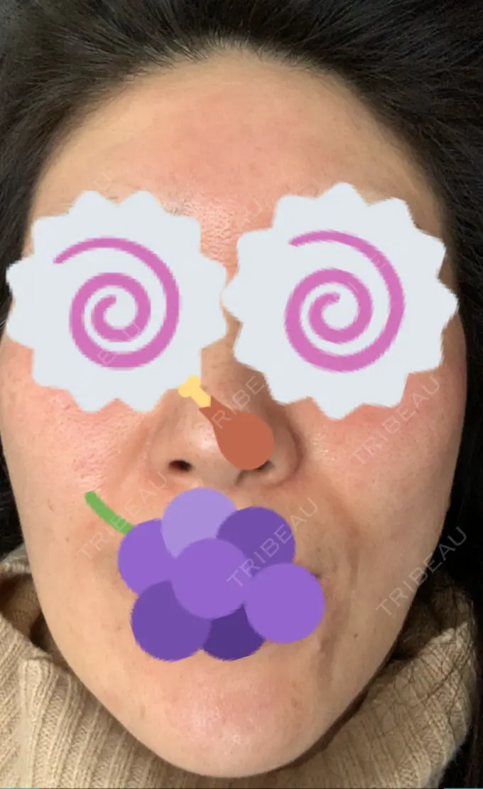 ピーリング（ニキビ・毛穴） / イオン導入 / エレクトロポレーション / 毛穴洗浄（ハイドラフェイシャルなど） あおばクリニック 横浜院 DAY 16 メイン用