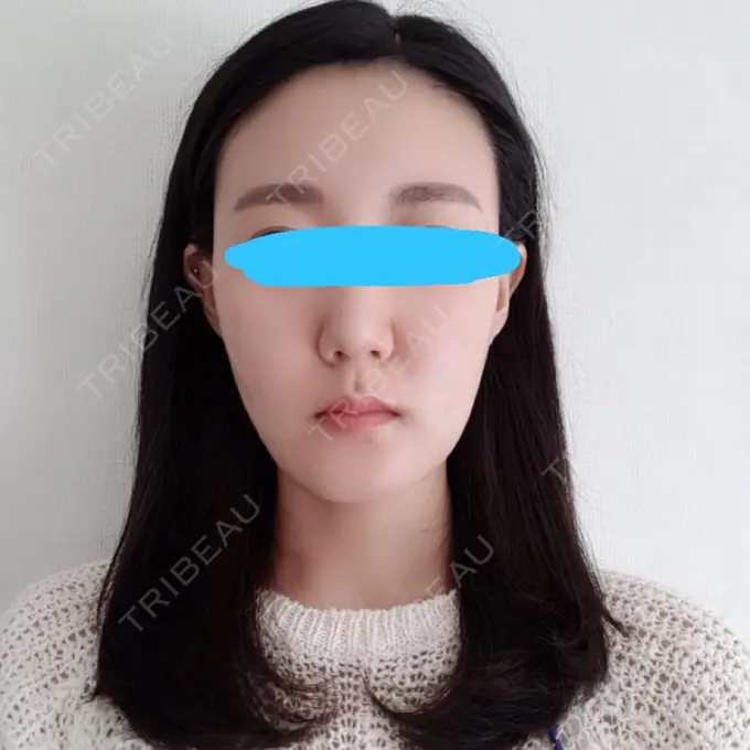 脂肪注入（輪郭） スノウ（Snow）整形外科 AFTER メイン用