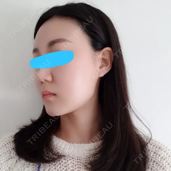 脂肪注入（輪郭） スノウ（Snow）整形外科 DAY 8 メイン用