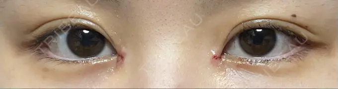 蒙古ひだ形成 R.O.clinic DAY 6 メイン用