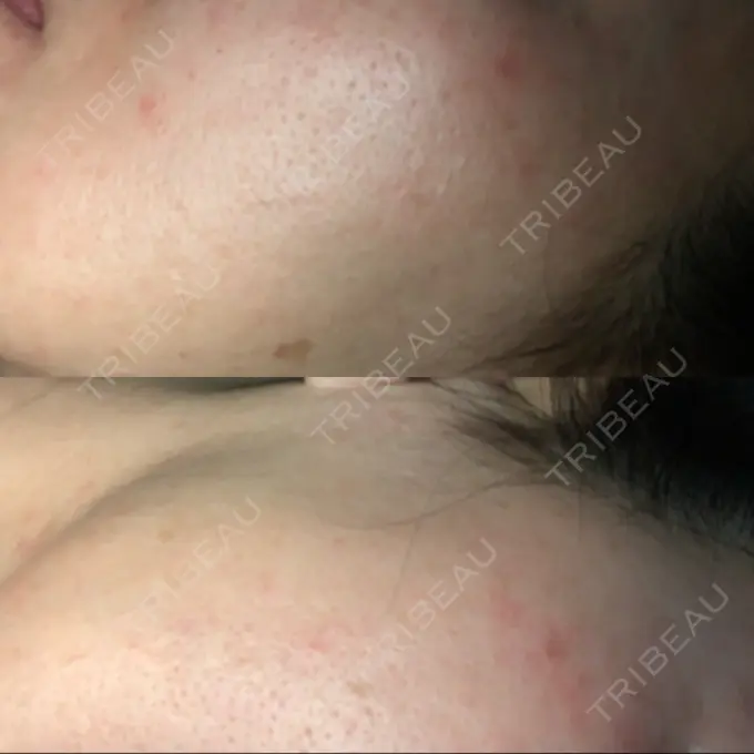 ピーリング（ニキビ・毛穴） / イオン導入 / エレクトロポレーション / 毛穴洗浄（ハイドラフェイシャルなど） あおばクリニック 横浜院 DAY 16 メイン用