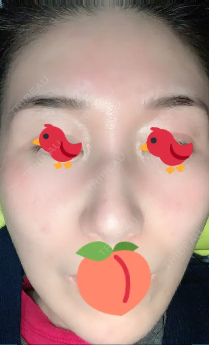 ピーリング（ニキビ・毛穴） / イオン導入 / エレクトロポレーション / 毛穴洗浄（ハイドラフェイシャルなど） あおばクリニック 横浜院 DAY 16 メイン用