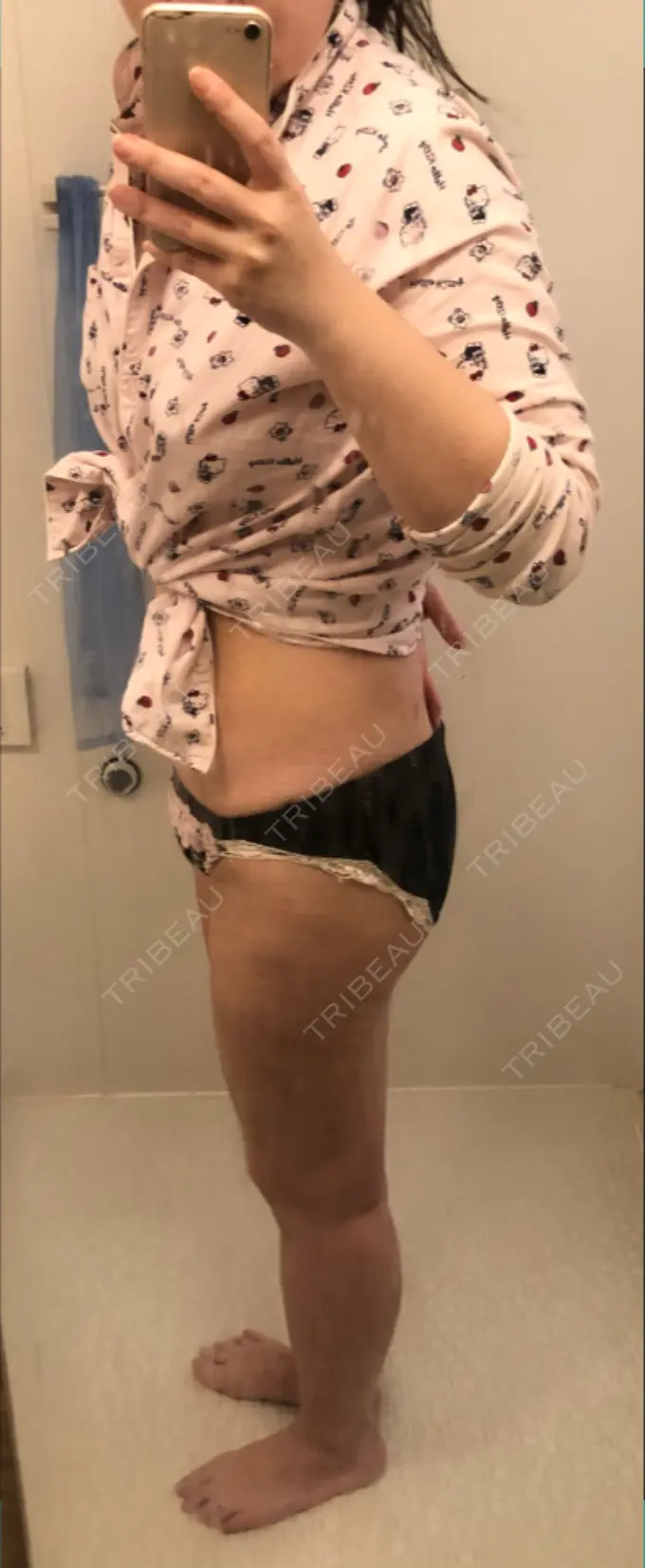 脂肪吸引（脚） 湘南美容クリニック 新橋銀座口院 DAY 18 メイン用