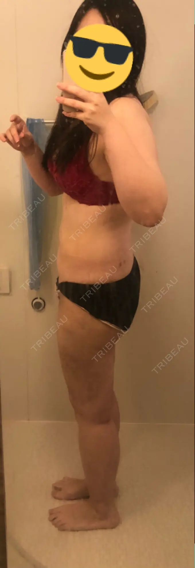 脂肪吸引（脚） 湘南美容クリニック 新橋銀座口院 DAY 19 メイン用