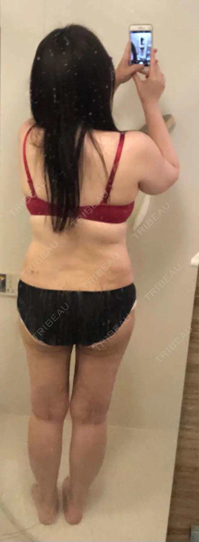 脂肪吸引（脚） 湘南美容クリニック 新橋銀座口院 DAY 19 メイン用