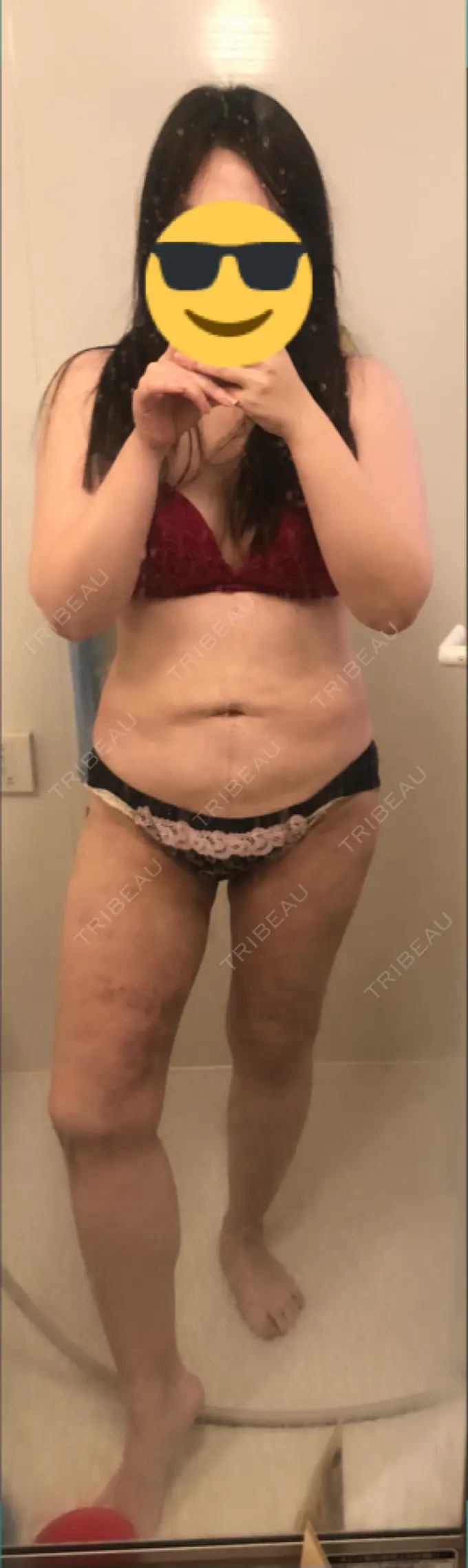 脂肪吸引（脚） 湘南美容クリニック 新橋銀座口院 DAY 19 メイン用