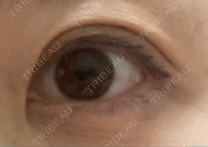 眼瞼下垂（切開） 銀座すみれの花 形成クリニック DAY 28 メイン用