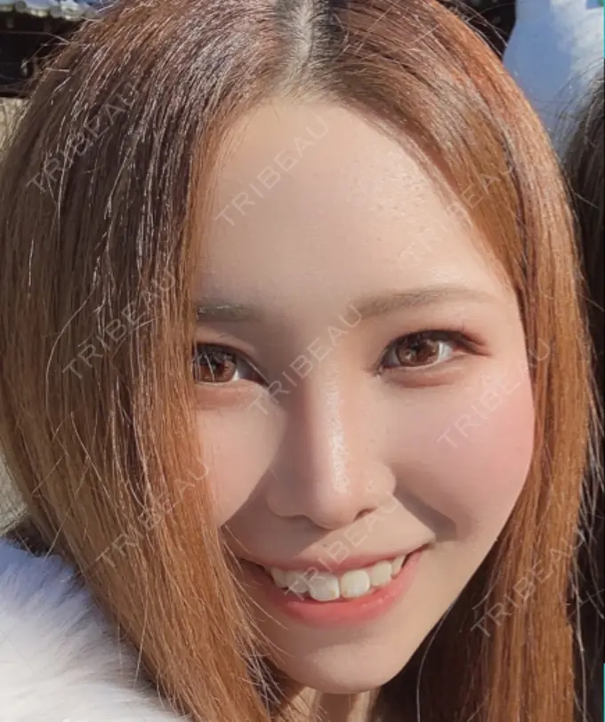 鼻尖形成（切開） / 鼻中隔延長（切開） / 軟骨移植 / 鼻孔縁下降 / その他（鼻） 湘南美容クリニック 新宿本院 DAY 253 メイン用