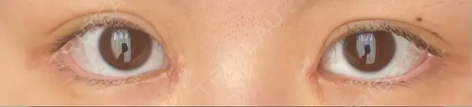 蒙古ひだ形成 R.O.clinic DAY 8 メイン用