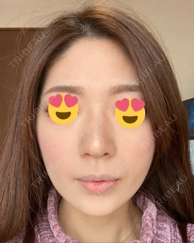 脂肪吸引（顔） ジョウクリニック 大阪院 DAY 87 メイン用