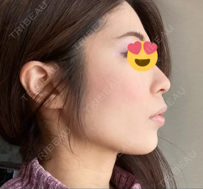 脂肪吸引（顔） ジョウクリニック 大阪院 AFTER メイン用