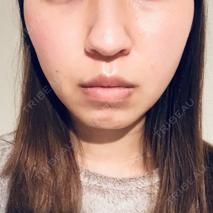 糸リフト 湘南美容クリニック 東京蒲田院 DAY 7 メイン用