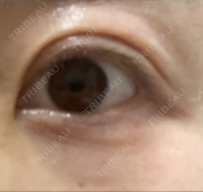 眼瞼下垂（切開） 銀座すみれの花 形成クリニック DAY 31 メイン用