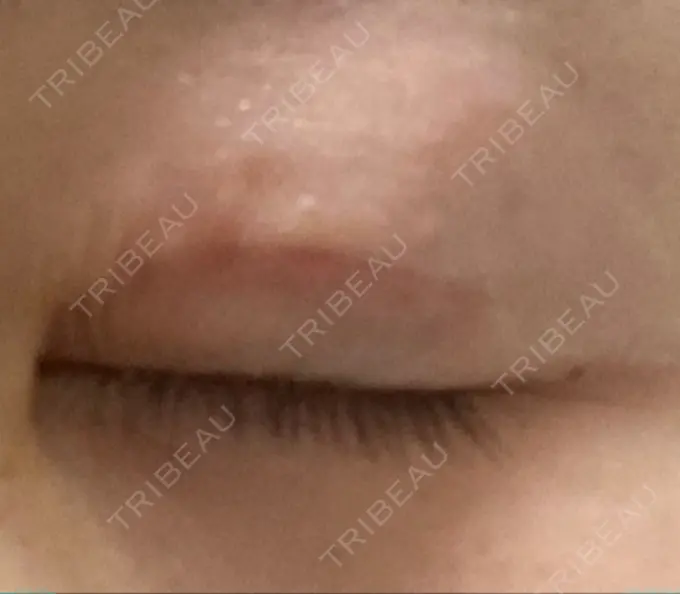 眼瞼下垂（切開） 銀座すみれの花 形成クリニック DAY 31 メイン用