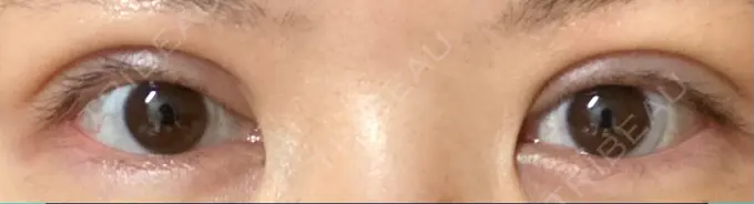 二重切開 / 上まぶたの脂肪取り 城本クリニック 豊橋院 DAY 118 メイン用