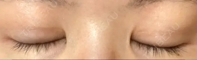 二重切開 / 上まぶたの脂肪取り 城本クリニック 豊橋院 DAY 118 メイン用