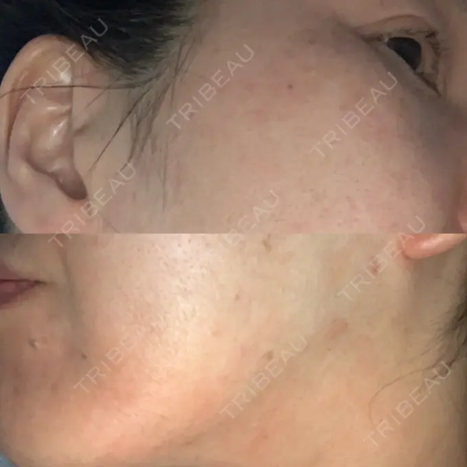 ピーリング（ニキビ・毛穴） / イオン導入 / エレクトロポレーション / 毛穴洗浄（ハイドラフェイシャルなど） あおばクリニック 横浜院 DAY 20 メイン用