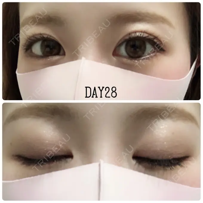 二重埋没 X CLINIC 恵比寿院 DAY 28 メイン用