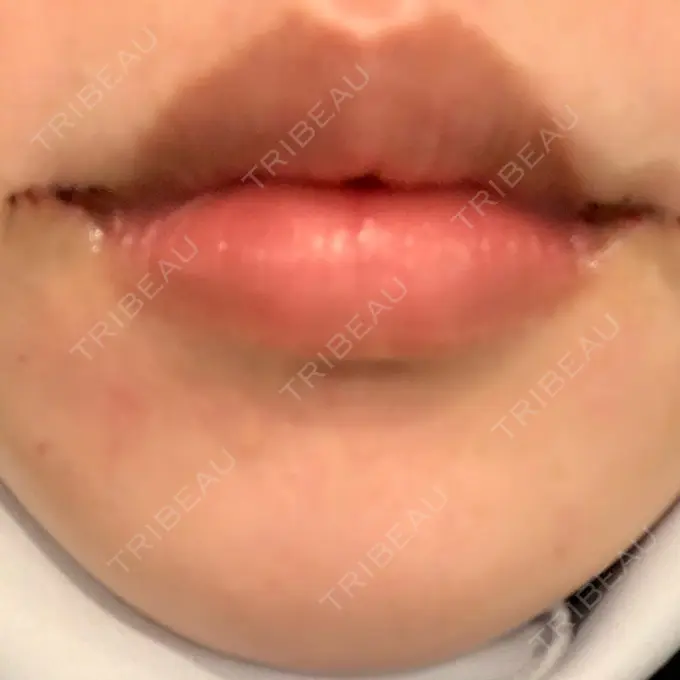 口角挙上 eクリニック 金沢本院 DAY 3 メイン用