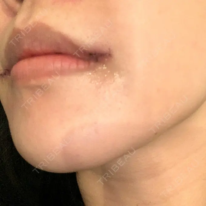 口角挙上 eクリニック 金沢本院 DAY 3 メイン用