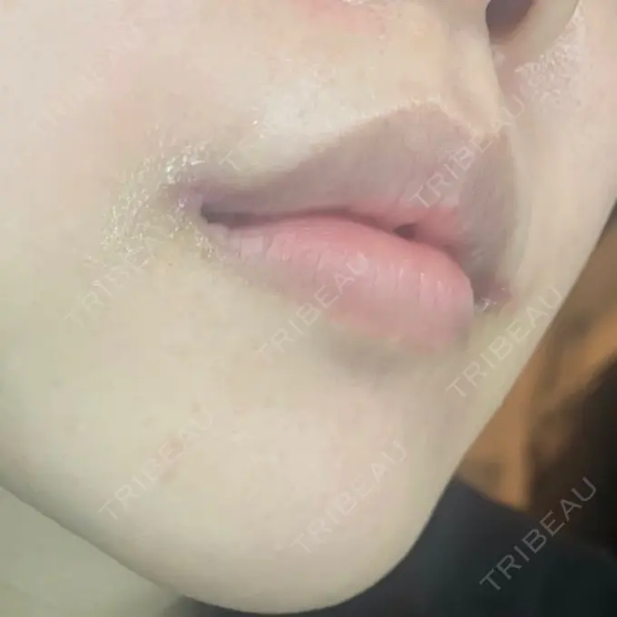 口角挙上 eクリニック 金沢本院 DAY 7 メイン用