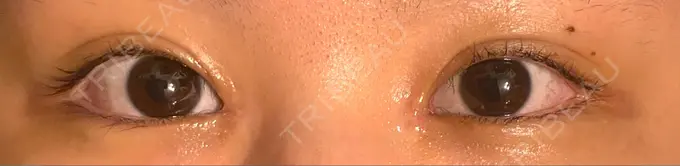 蒙古ひだ形成 R.O.clinic DAY 11 メイン用