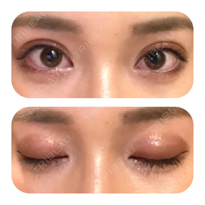 二重埋没 ハナビューティークリニック DAY 31 メイン用