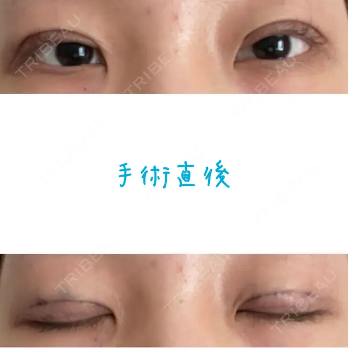 二重埋没 湘南美容クリニック 大阪あべの院 DAY 0 メイン用