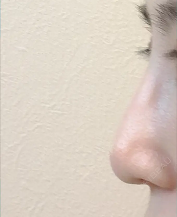 鼻尖形成（切開） / 軟骨移植 / ワシ鼻修正・ハンプ切除 麹町皮ふ科・形成外科クリニック AFTER メイン用