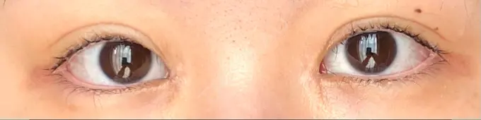 蒙古ひだ形成 R.O.clinic DAY 13 メイン用