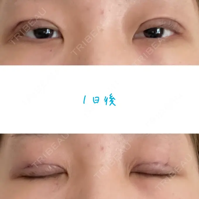 二重埋没 湘南美容クリニック 大阪あべの院 DAY 1 メイン用