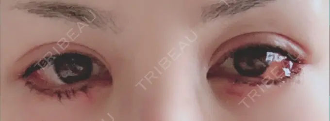 目尻切開 / タレ目形成・グラマラスライン（切開） 高須クリニック 大阪院 DAY 2 メイン用