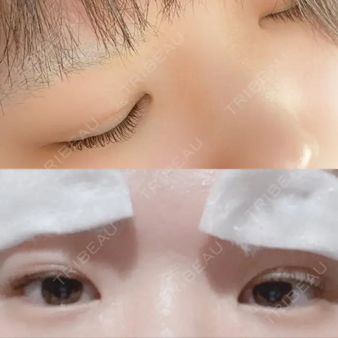 二重埋没 湘南美容クリニック 橋本院 AFTER メイン用