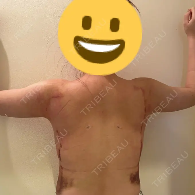 脂肪吸引（二の腕） 湘南美容クリニック 新橋銀座口院 DAY 4 メイン用