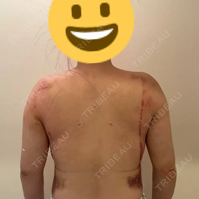 脂肪吸引（二の腕） 湘南美容クリニック 新橋銀座口院 DAY 4 メイン用