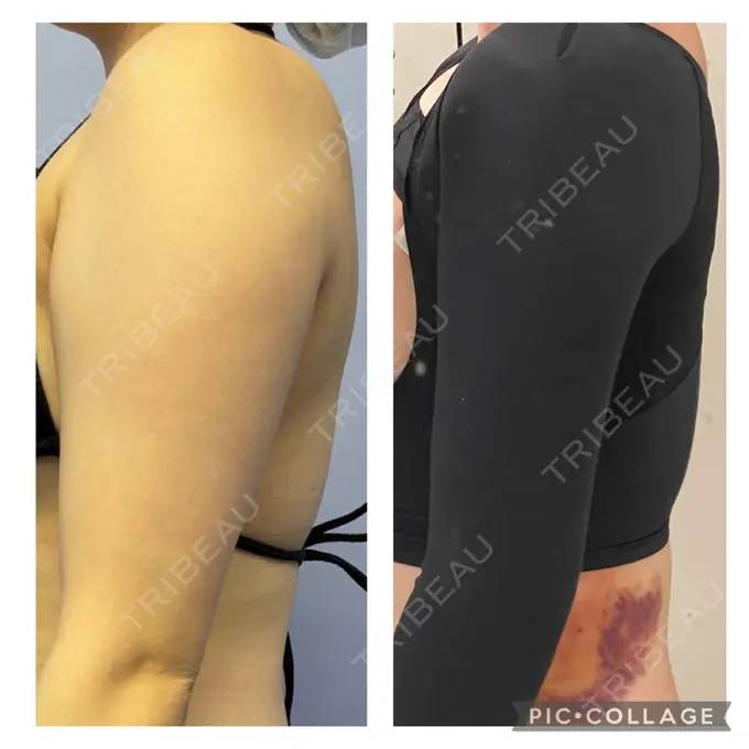 脂肪吸引（二の腕） 湘南美容クリニック 新橋銀座口院 DAY 5 メイン用