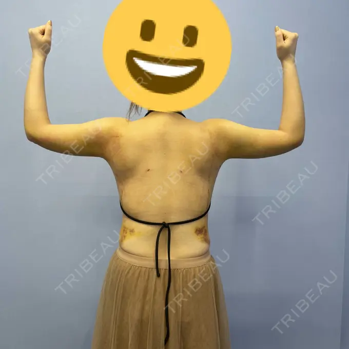 脂肪吸引（二の腕） 湘南美容クリニック 新橋銀座口院 DAY 7 メイン用