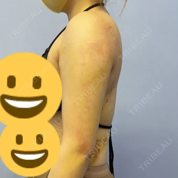 脂肪吸引（二の腕） 湘南美容クリニック 新橋銀座口院 DAY 7 メイン用