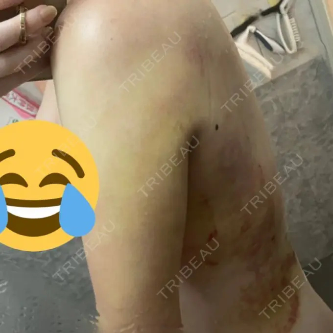 脂肪吸引（二の腕） 湘南美容クリニック 新橋銀座口院 DAY 8 メイン用