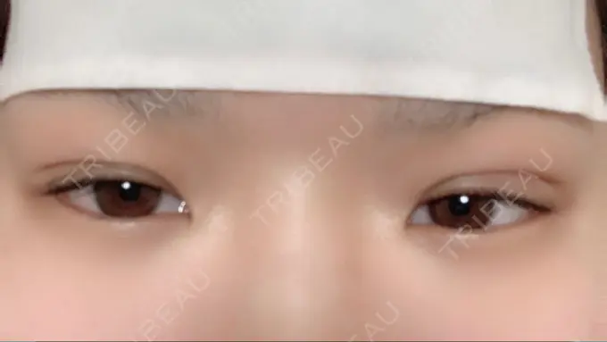 二重埋没 湘南美容クリニック 橋本院 DAY 0 メイン用