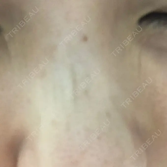 ボトックス（あご） 湘南美容クリニック 銀座院 DAY 12 メイン用