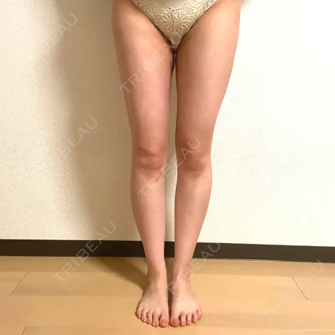 脂肪吸引（脚） 湘南美容クリニック 札幌院 AFTER メイン用