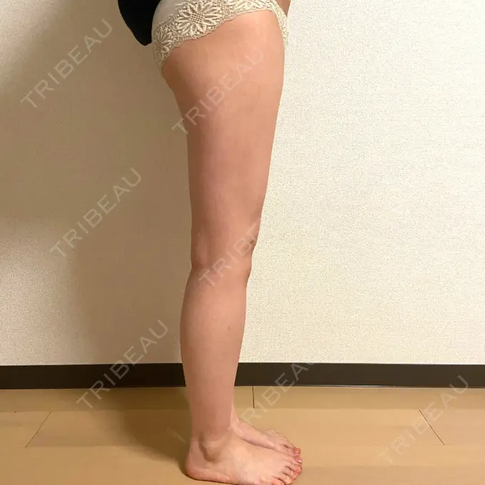 脂肪吸引（脚） 湘南美容クリニック 札幌院 DAY 62 メイン用