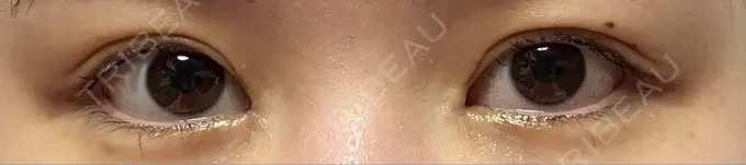 蒙古ひだ形成 R.O.clinic DAY 13 メイン用