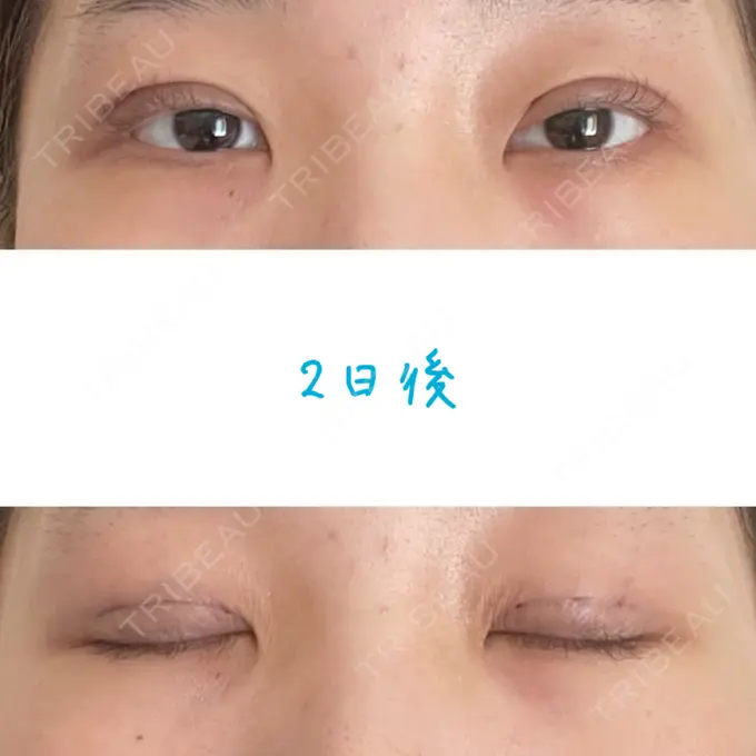 二重埋没 湘南美容クリニック 大阪あべの院 DAY 2 メイン用