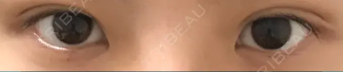 二重埋没 かわた美容クリニック AFTER メイン用