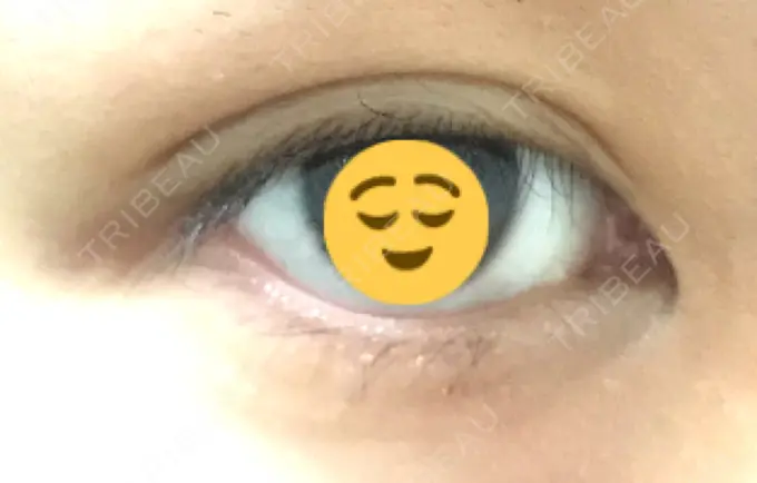 二重埋没 かわた美容クリニック DAY 77 メイン用