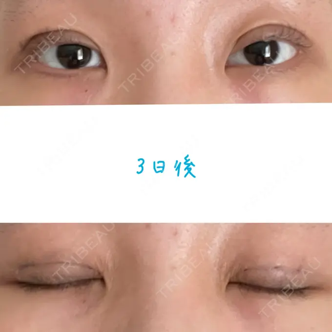 二重埋没 湘南美容クリニック 大阪あべの院 DAY 3 メイン用