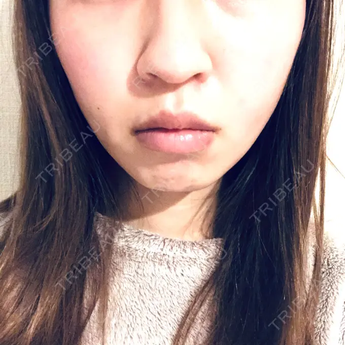 糸リフト 湘南美容クリニック 東京蒲田院 DAY 14 メイン用